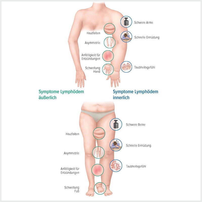 Grafische Darstellung der Symptome eines Lymphödems | deinestarkeseite.de