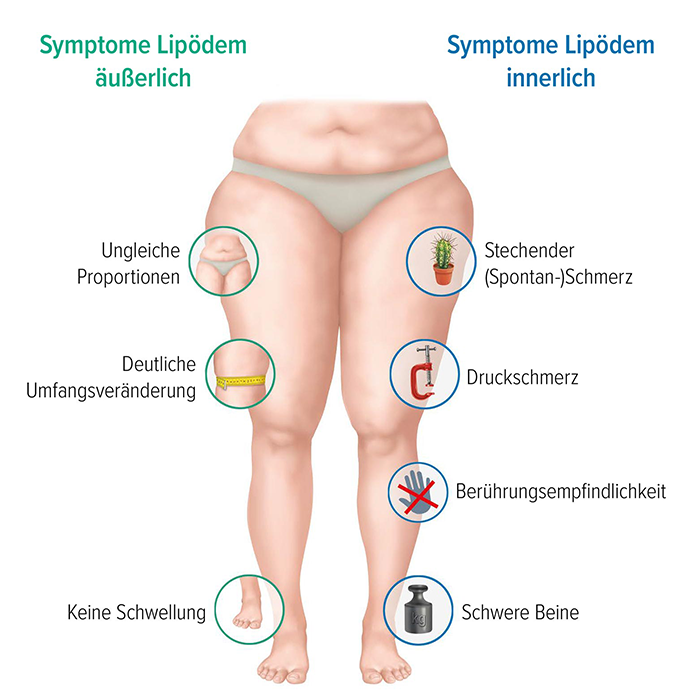 Grafische Darstellung der Symptome eines Lipödems