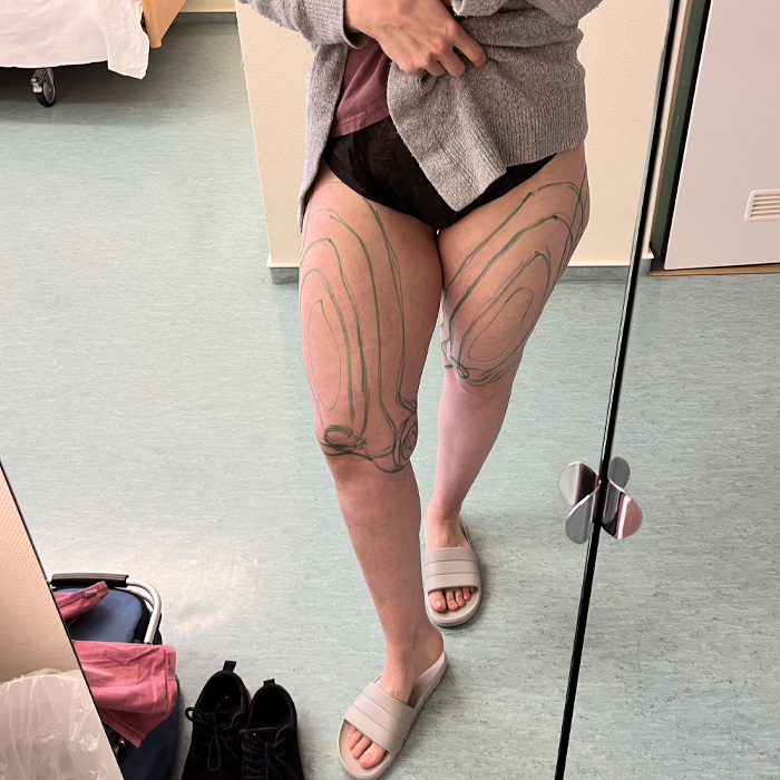 Elisa bei der Liposuktion